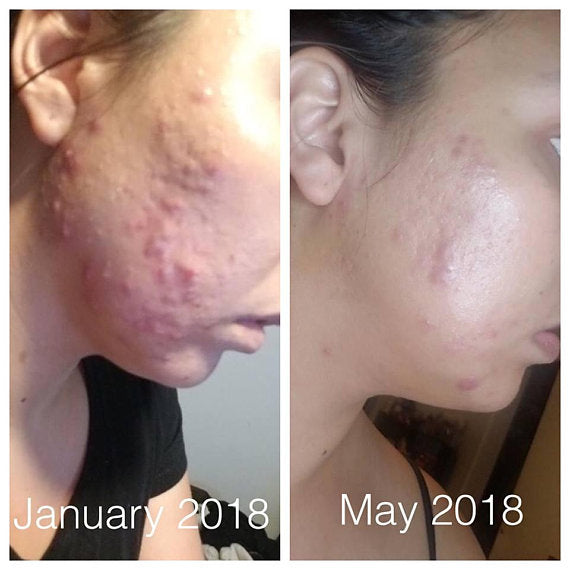super acne fighter / organic treatment sup | dropsona - neutral - material texture