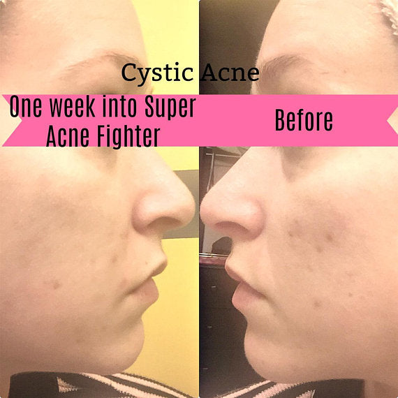 super acne fighter / organic treatment sup | dropsona - neutral - close-up detail